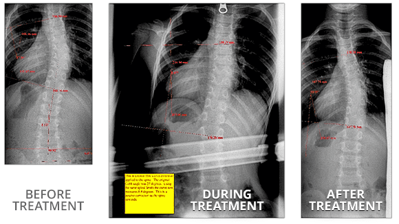 Hudson Valley Scoliosis Exercise Based Scoliosis Treatment