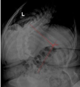 Severe Scoliosis A Guide To Nonsurgical Treatment Options