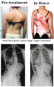 Scoliosis Boston Brace at Rs 7500/piece