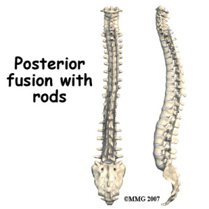 A Brief History Of Scoliosis Surgery - Strauss Scoliosis Correction