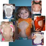 infantile scoliosis casting