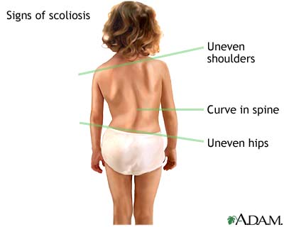 do I have scoliosis