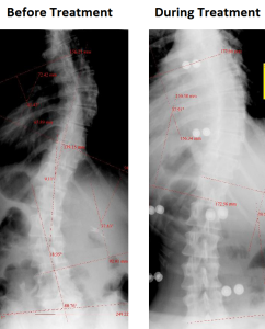 Scoliosis Treatment Results - Strauss Scoliosis Correction