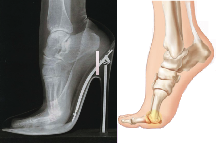 Wearing heels can lead to these 5 health problems | HealthShots