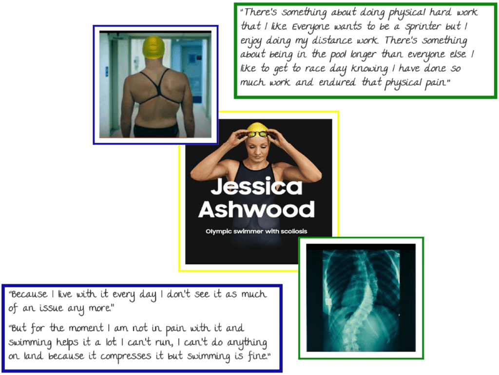 Chloe Sevigny S Scoliosis Story Strauss Scoliosis Cor - vrogue.co