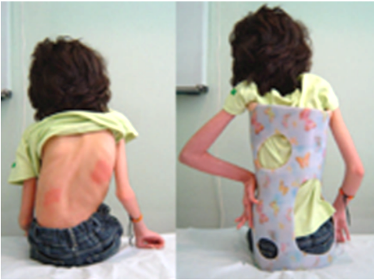Proposed scoliosis brace on patient: (a) front and (b) back