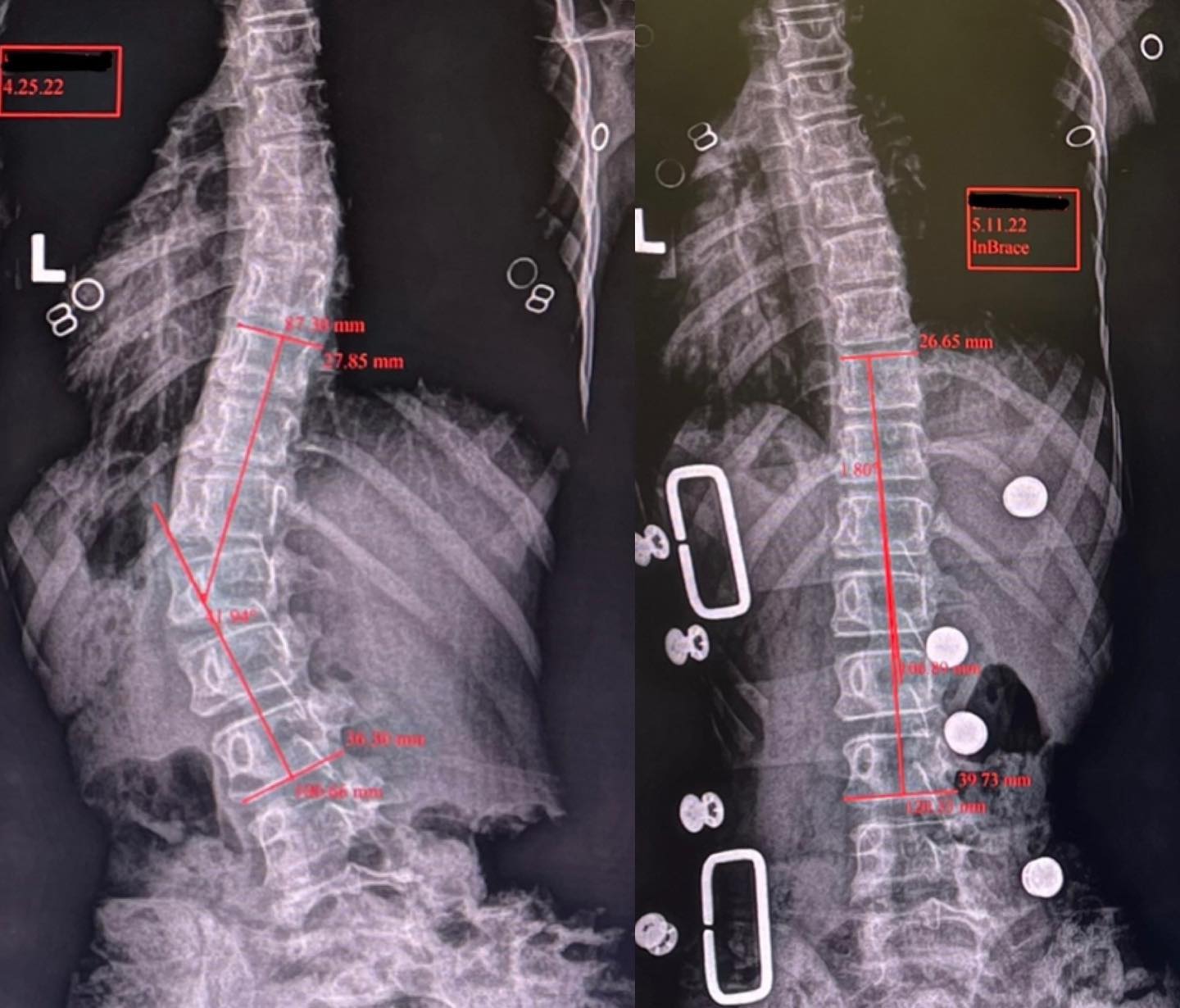 Strauss Scoliosis Correction: Keeping Patients Ahead Of The Curve